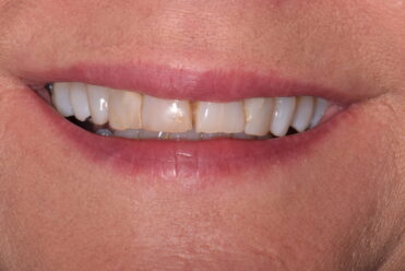 Before - Smile Design Dental 