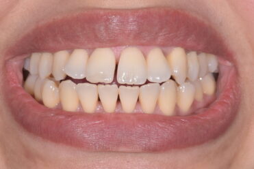 Before - Smile Design Dental 